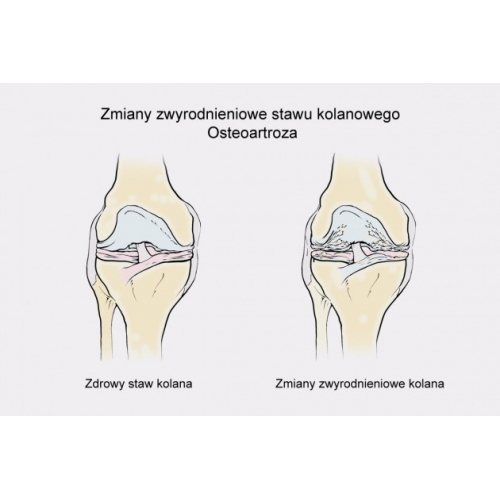 Jednoszynowa odciążająca orteza na goleń i udo z anatomiczną regulacją zakresu ruchomości i dynamicznymi pasami spiralnymi ATTACK 2RA