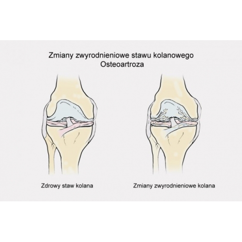 Jednoszynowa odciążająca orteza na goleń i udo z regulacją zakresu ruchomości co 15 stopni i dynamicznymi pasami spiralnymi ATTACK 1R